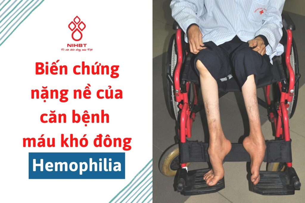 điều trị dự phòng cho người có hemophilia