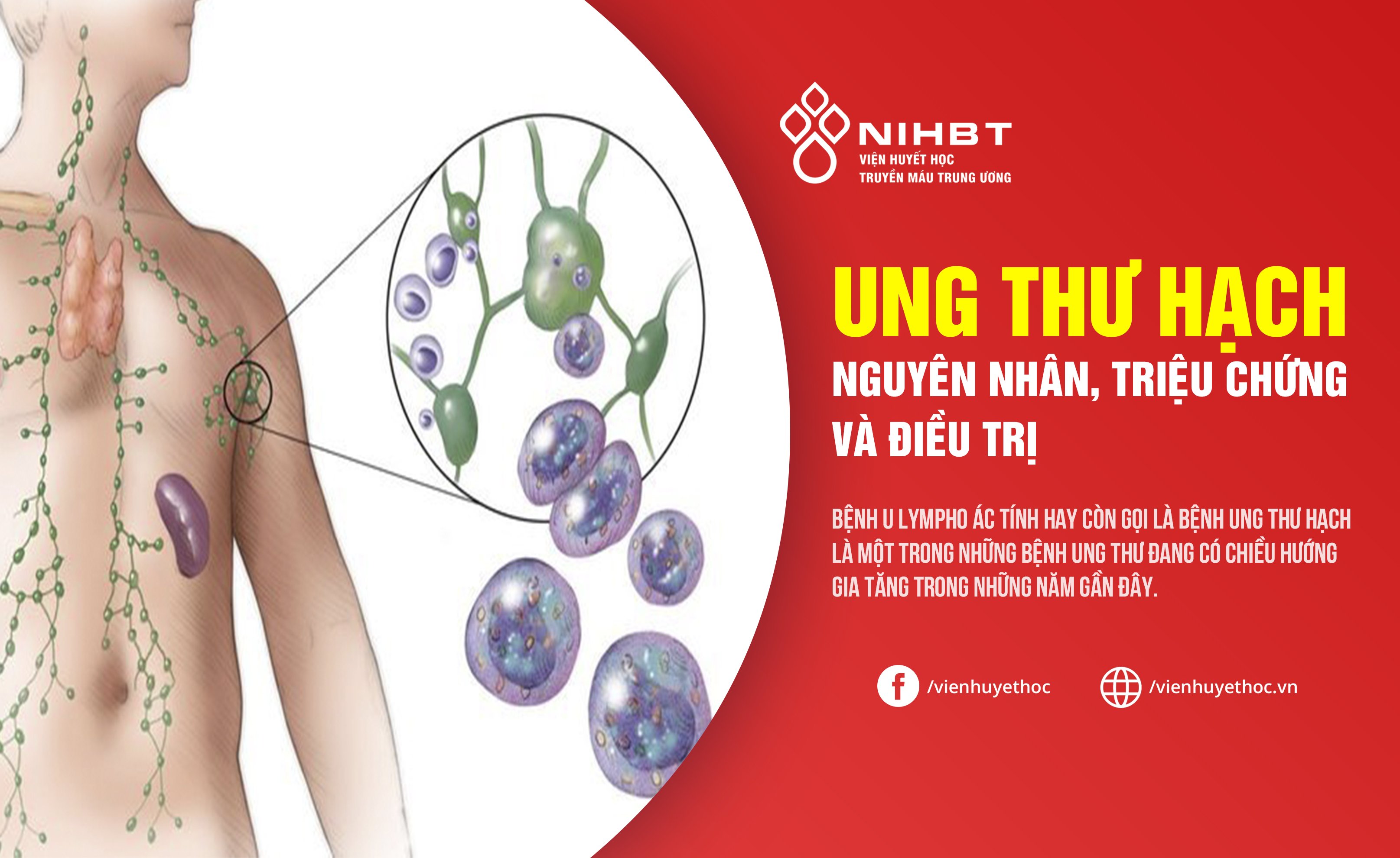 U Lympho Dạng Không Phải Nang Là Gì? Tìm Hiểu Chi Tiết Về Triệu Chứng, Chẩn Đoán và Điều Trị