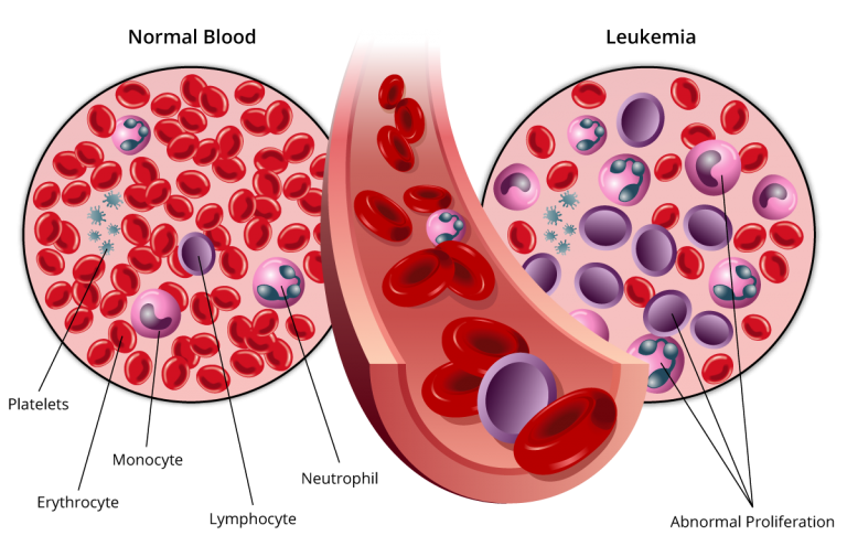 Normal blood vs Leukemia